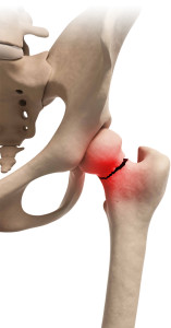 Nutricia frattura femore