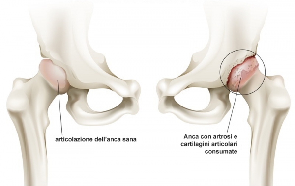 nutricia artrosi anca